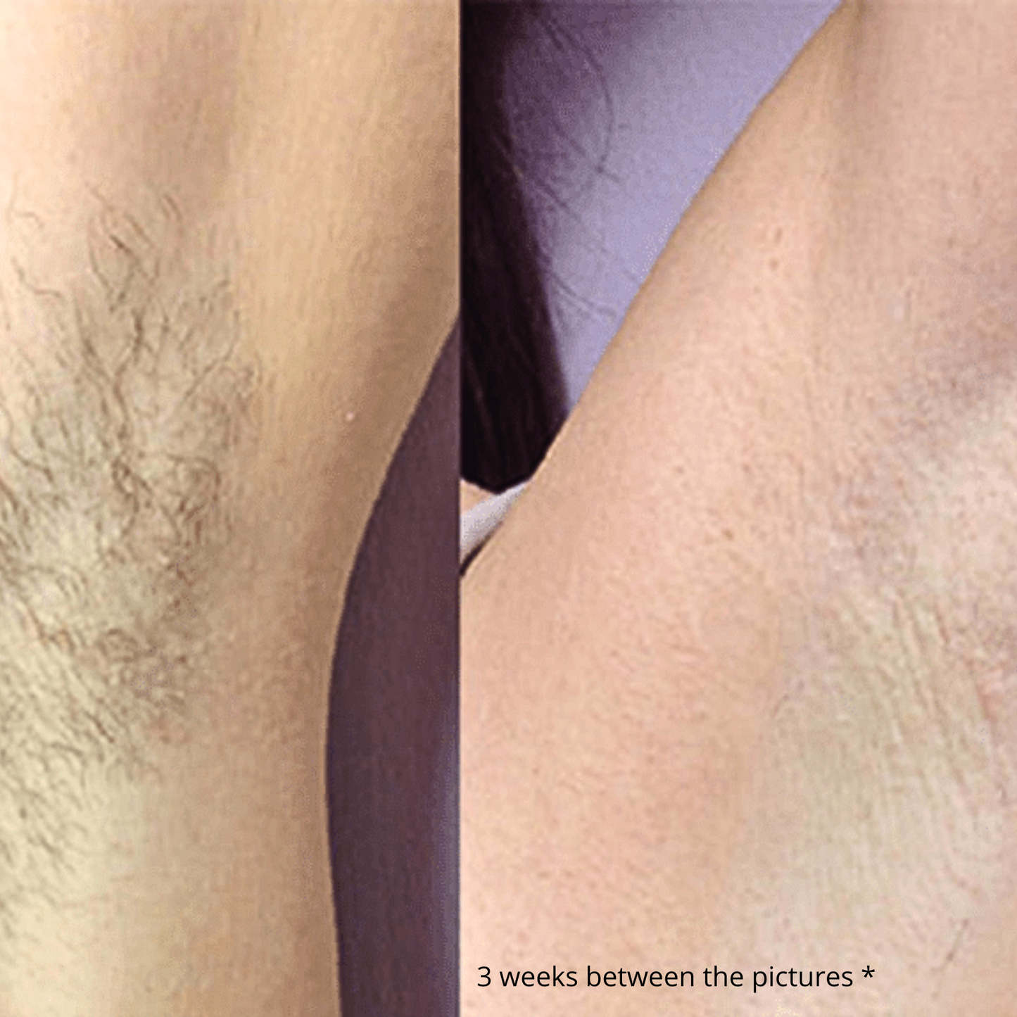 Selfscious SilkaLite IPL Hair Remover™