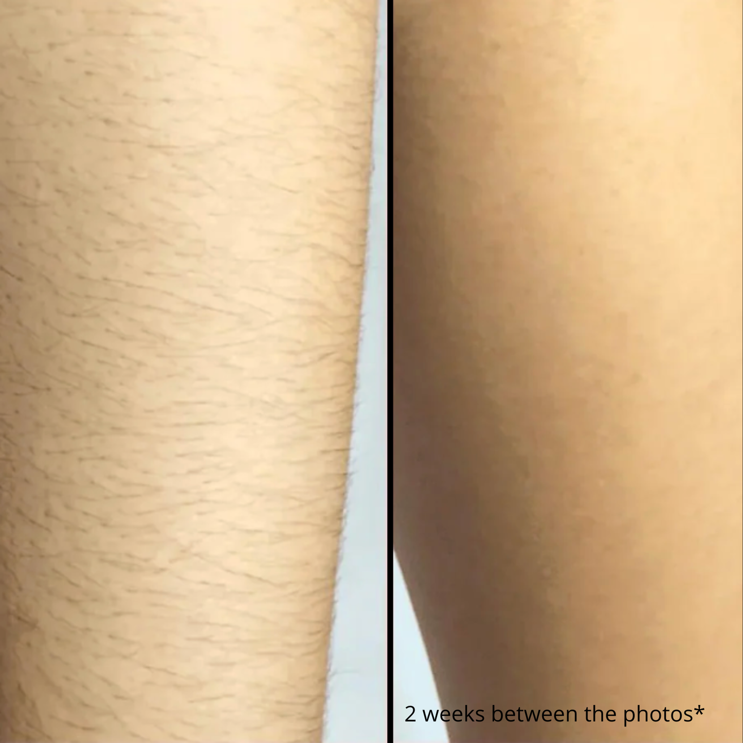 Selfscious SilkaLite IPL Hair Remover™